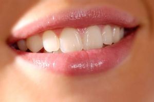veneers_crowns_central_dentists_tingalpa veneers brisbane carindale