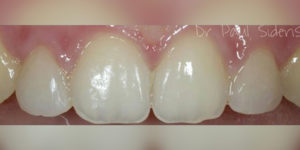 Porcelain Veneers Brisbane Dentist Tingalpa