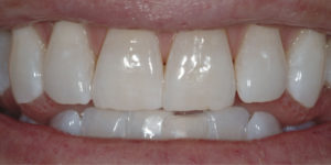 zoom whitening brisbane