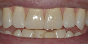 Philips Zoom before Brisbane dentist