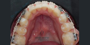 orthodontics in Brisbane, braces, invisalign, carindale