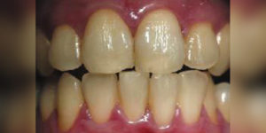 Before