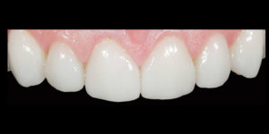 Composite and Porcelain Veneers Brisbane