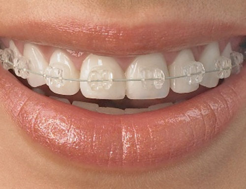 An Advanced Orthodontic Method available in Brisbane : Fastbraces®